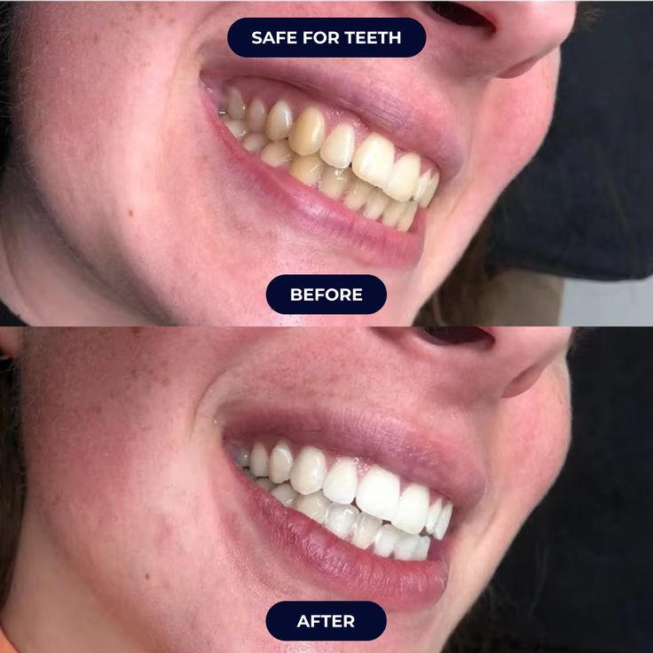German Gaelibai Probiotics Whitening